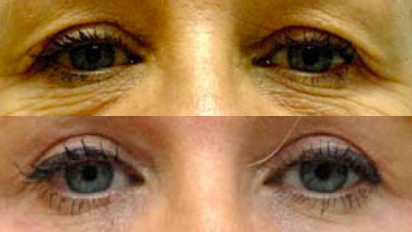 blepharoplasty showing before and after effect