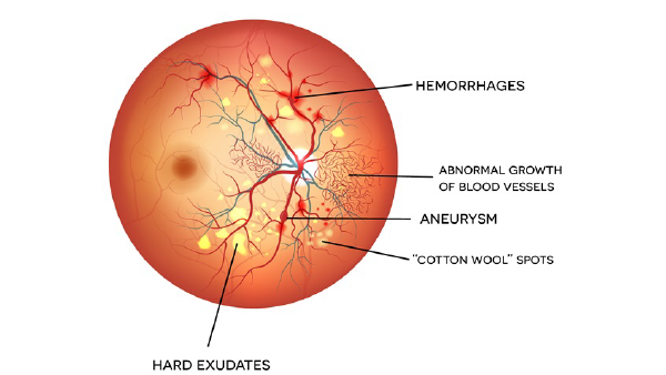 anatomy image showing diabetic retinopathy