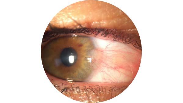 Pterygium shown on an eye