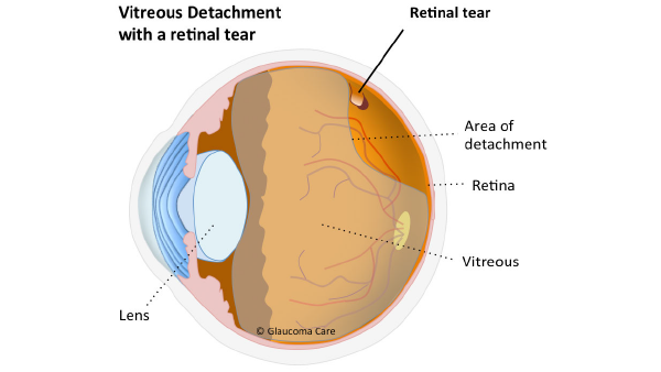 anatomy diagram showing retinal tears and detachment