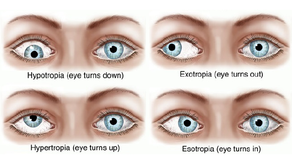 Strabismus eye conditions