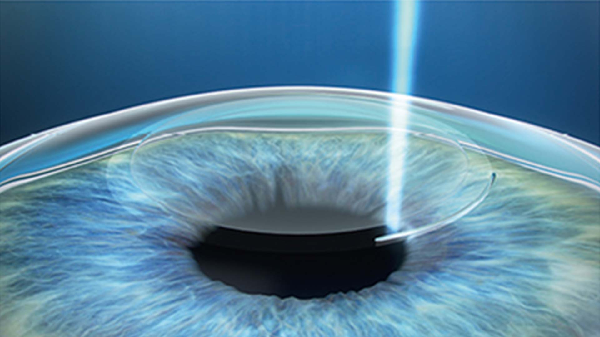 近视矫正手术如何选择最适合自己的激光角膜屈光手术方式_患者