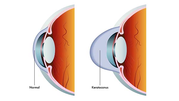 Anatomy image showing Keratoconus
